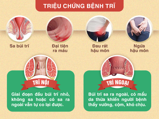 Phương pháp trị liệu bệnh trĩ nội